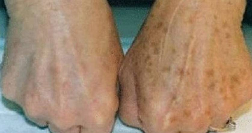 Sonnenflecken / Altersflecken